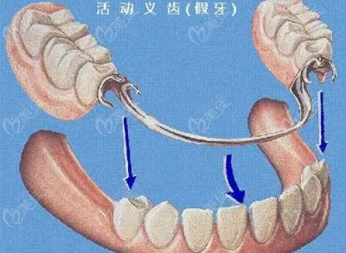 太原半全口活动假牙价格