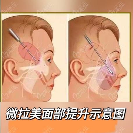 上海微拉美面部提升过程图解