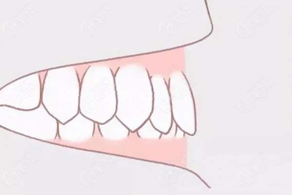 闭锁性深覆合的危害