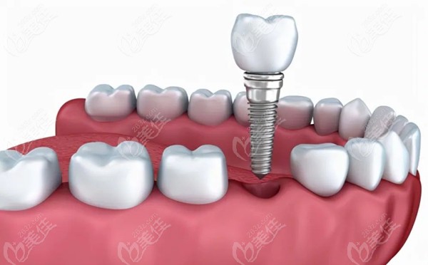 分析种植牙和普通假牙的区别