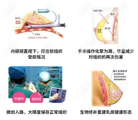 广州荔湾区<!--<i data=20240703-sp></i>-->胸部奥美定取出技术好