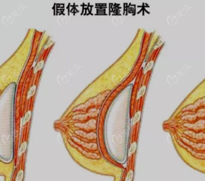 隆胸手术