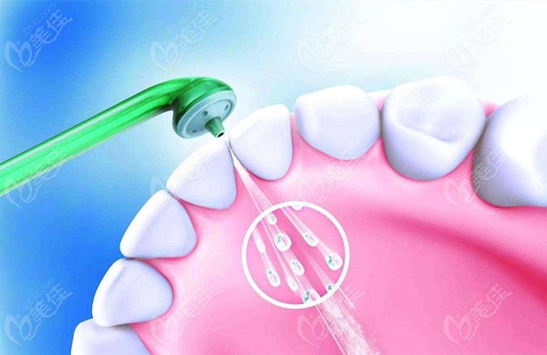 口腔医院洗牙的工具是一次性的吗