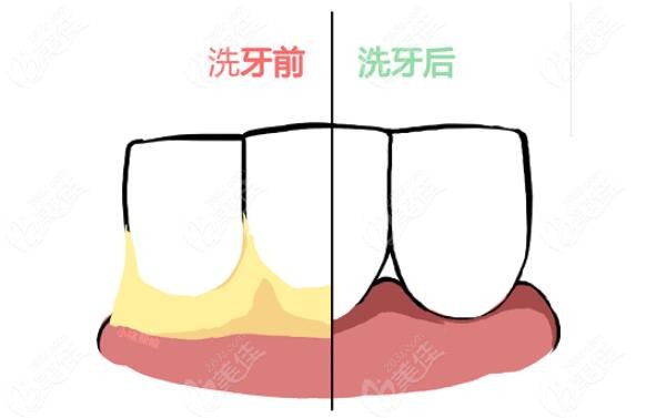 洗牙前后对比图