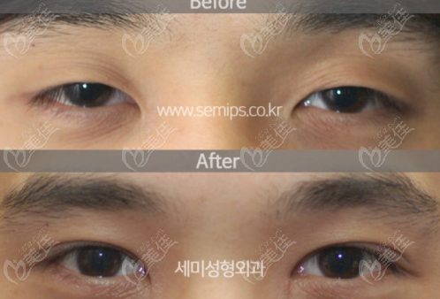 韩国世美男士双眼皮结果对比图参考一（m.236z.com）