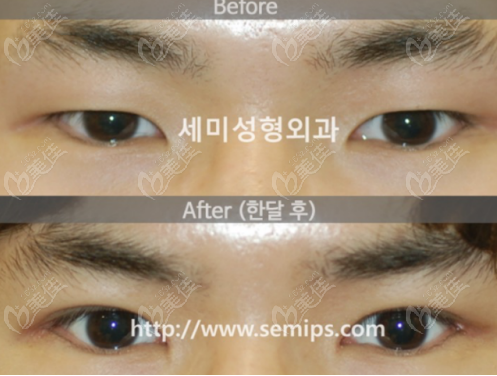 韩国世美男士双眼皮结果对比图参考二