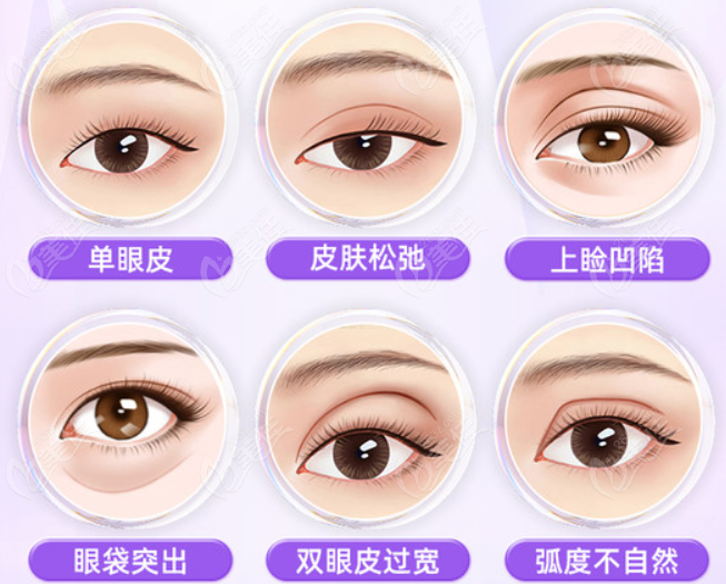 韩国来丽整形医院双眼皮多少钱