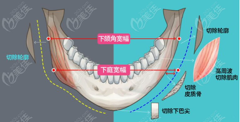 上海余东医生长曲线下颌角削骨怎么样