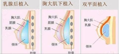 双平面隆胸比胸大肌下隆胸价格贵