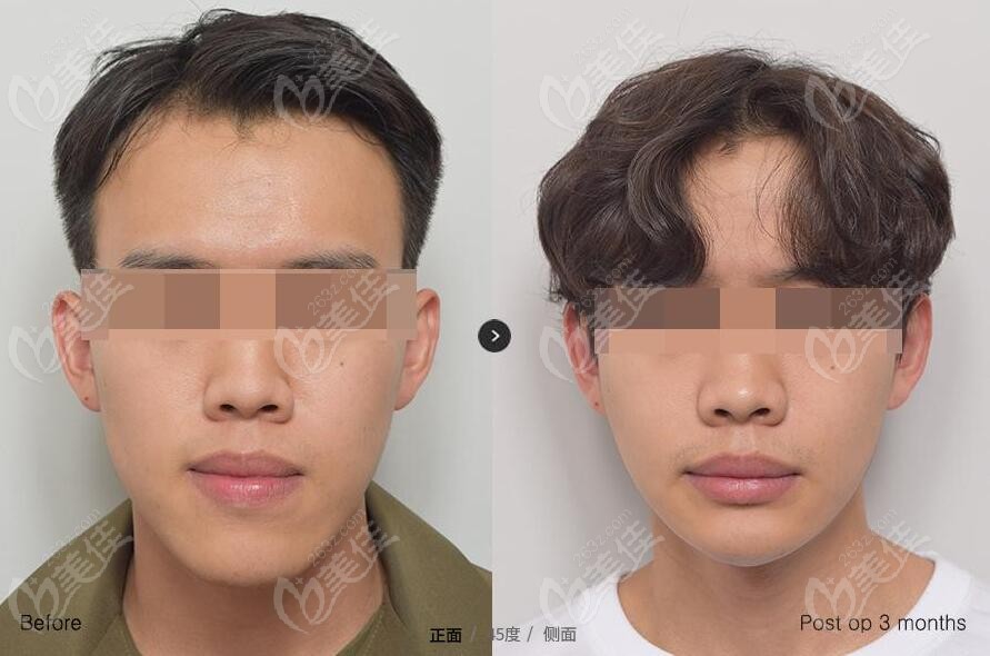 男士在韩国EU做双鄂手术+vline手术前后对比照