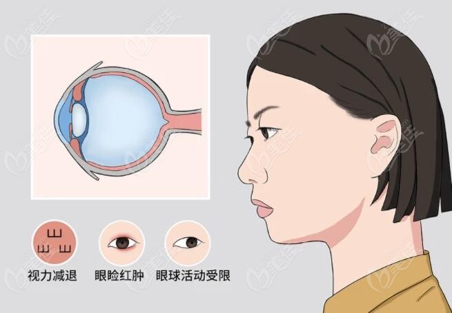 www.236z.com韩国必当归整形突眼矫正手术技术图