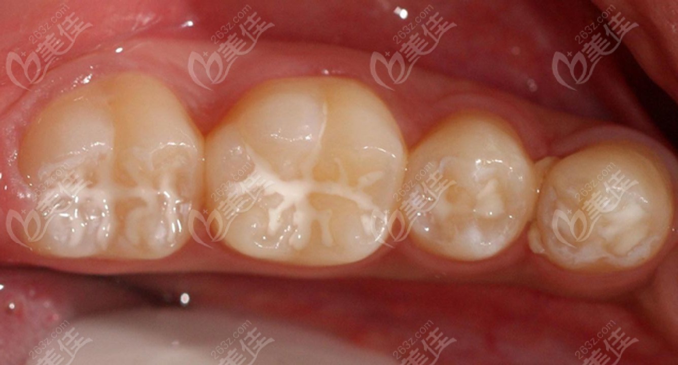浅龋补牙图片