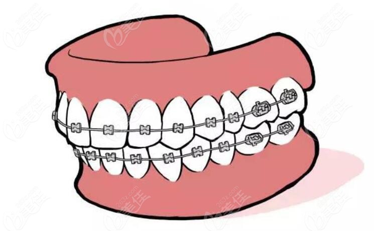 这是金属牙套卡通图