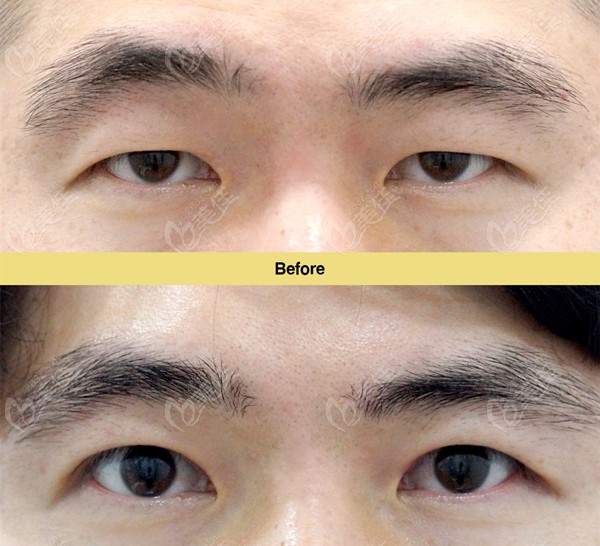 韩国优雅人整形的眼肌矫正+双眼皮手术,改善眼睑下垂的疗效也太好了吧