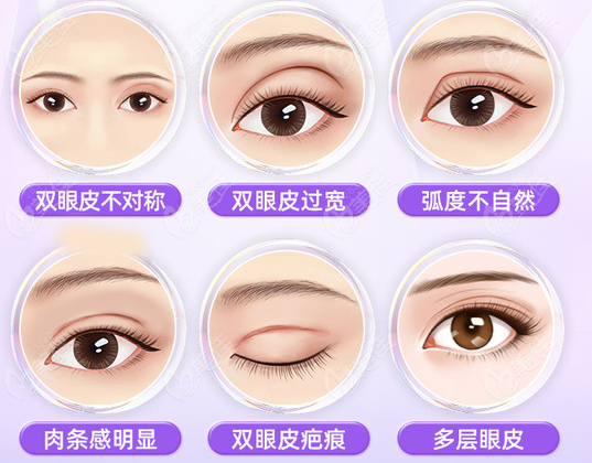 韩国双眼皮修复多少钱