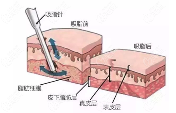 黄金微雕吸脂和普通吸脂不同点