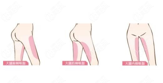 大腿吸脂后要痛多久m.236z.com