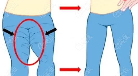 推荐去大腿吸脂的医院