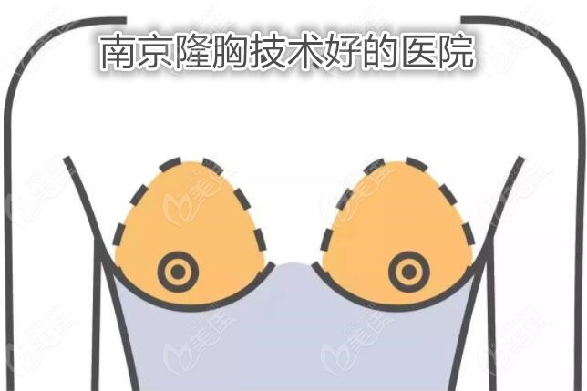 南京隆胸技术好的医院
