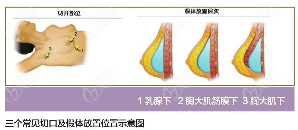 南京假体隆胸哪家医院好m.236z.com