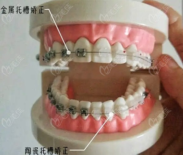 库尔勒牙齿矫正大概费用是多少?