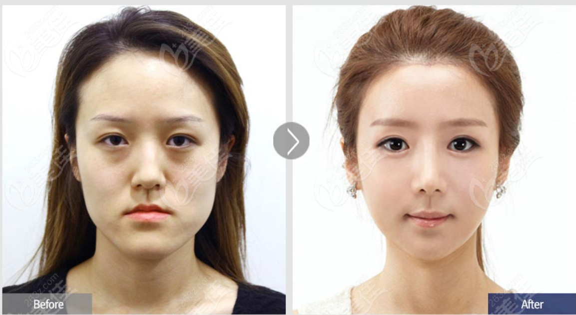 韩国菲斯莱茵smart双鄂手术前后对比照片