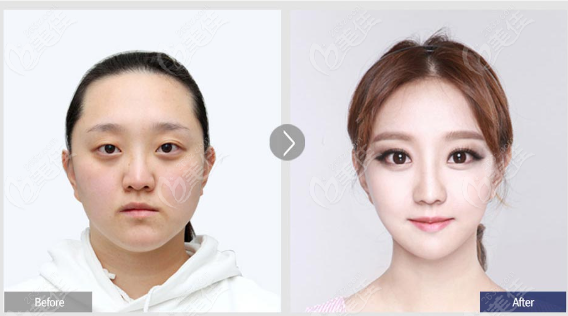 韩国菲斯莱茵faceline整形外科偏颌歪脸双鄂正颌手术一年对比图片