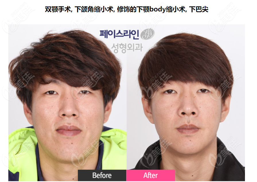 韩国菲斯莱茵医院男生长脸鞋拔子脸双鄂手术前后对比图片