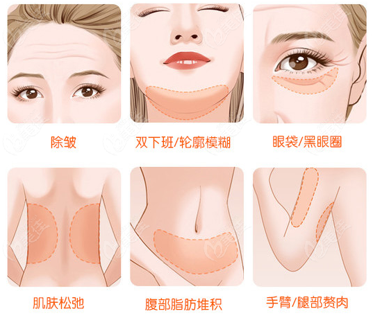 筋膜提拉术和埋线提升的区别分析@美佳网