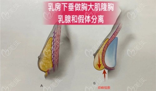 胸部下垂做胸大肌假体隆胸好还是不好www.236z.com