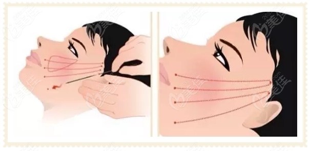 田永成TBM面部提升的手術(shù)優(yōu)勢點