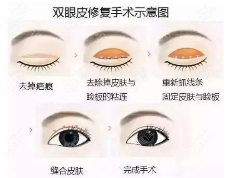 上海余东双眼皮修复手术过程和步骤