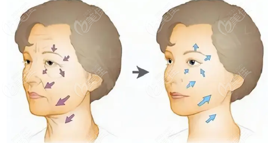 做了筋膜提升多久臉型可以出來