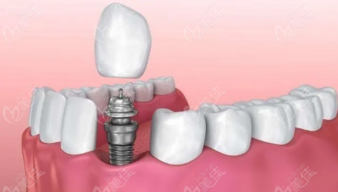 种植牙手术流程分别要间隔多久美佳网