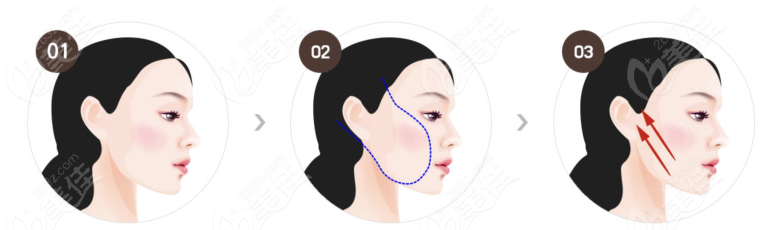 韓國面部年輕化醫(yī)院排名前三有韓國必當(dāng)歸整形