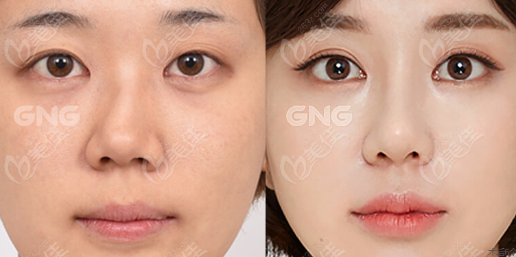 韩国gng整形医院歪鼻修复术前后对比图