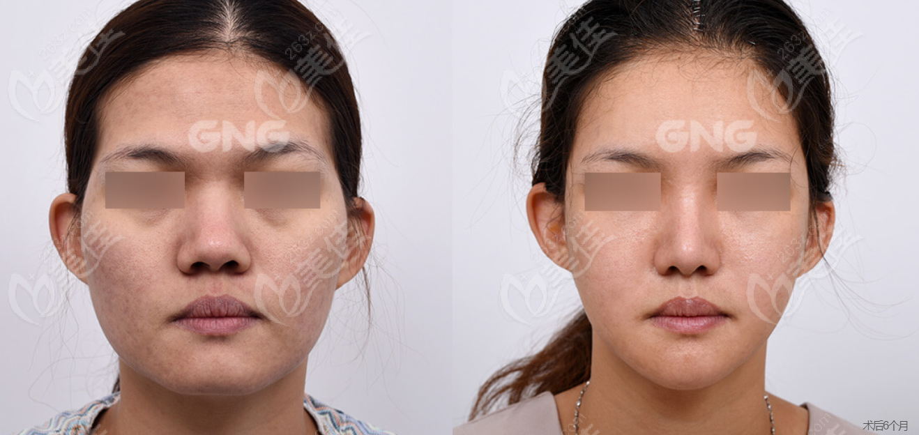 韩国GNG整形颧骨+下颌角改脸型对比图