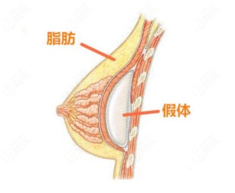 南宁格林美菲隆胸多少钱