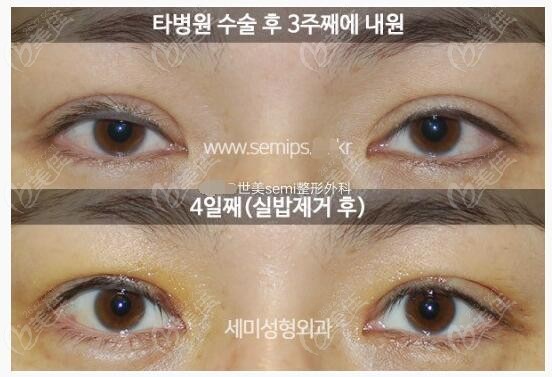 初次双眼皮过宽和不对称在韩国世美做眼修复手术+提肌矫正