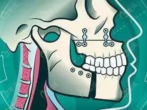 www.236z.com哈尔滨双颌手术费用多少钱