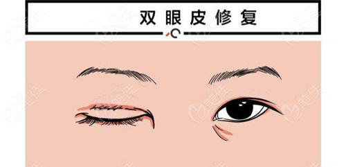 www.8682.cc哈尔滨刘长松修复双眼皮怎么样