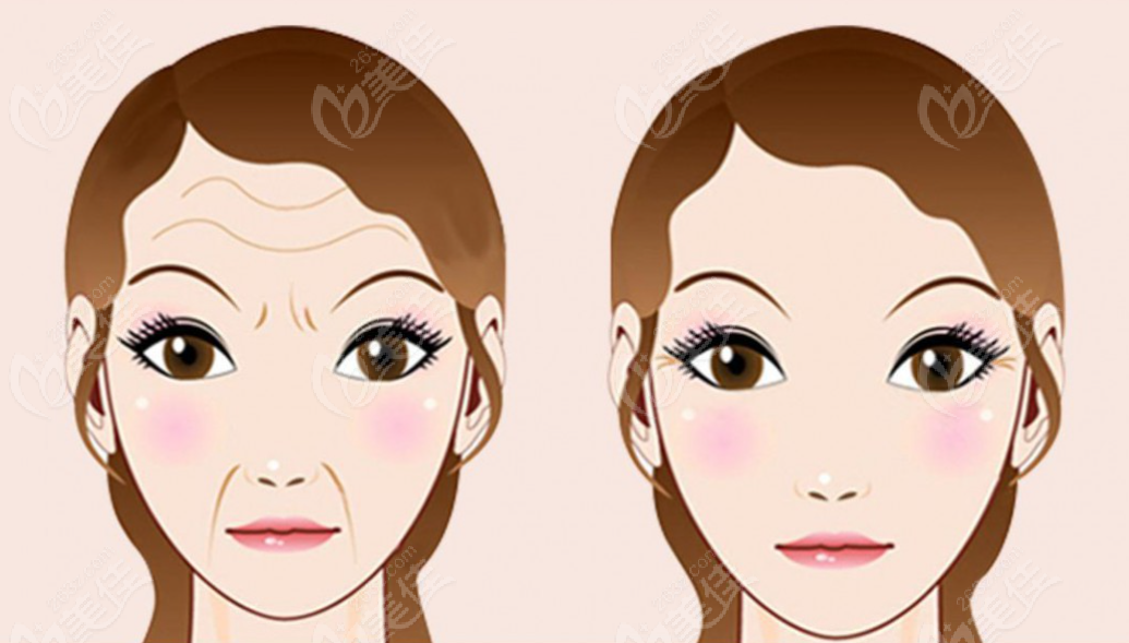 抬頭紋拉皮前后對比照片