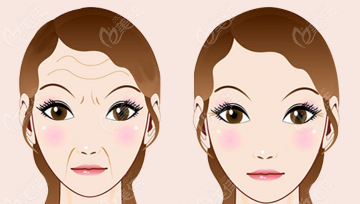 抬頭紋做拉皮手術(shù)圖片