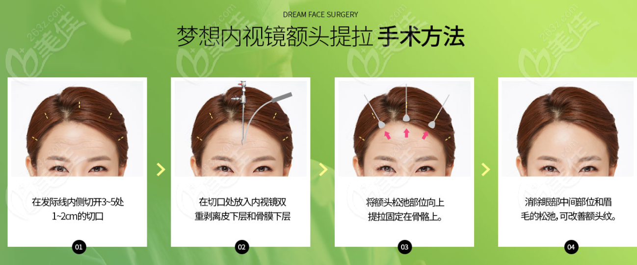 韓國夢想整形醫(yī)院額頭提升+抬頭紋拉皮手術(shù)過程圖片