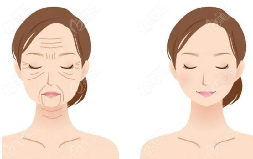 褶子深溝直線形抬頭紋拉皮前后對比照片