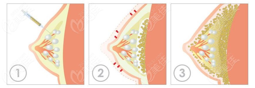 劉成勝脂肪豐胸技術(shù)優(yōu)勢(shì)m.236z.com