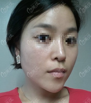 面部提升術(shù)后圖 美佳網(wǎng)