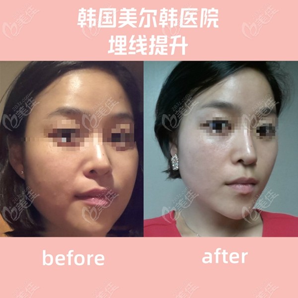 韓國美爾韓醫(yī)院埋線提升術(shù)前術(shù)后對比圖