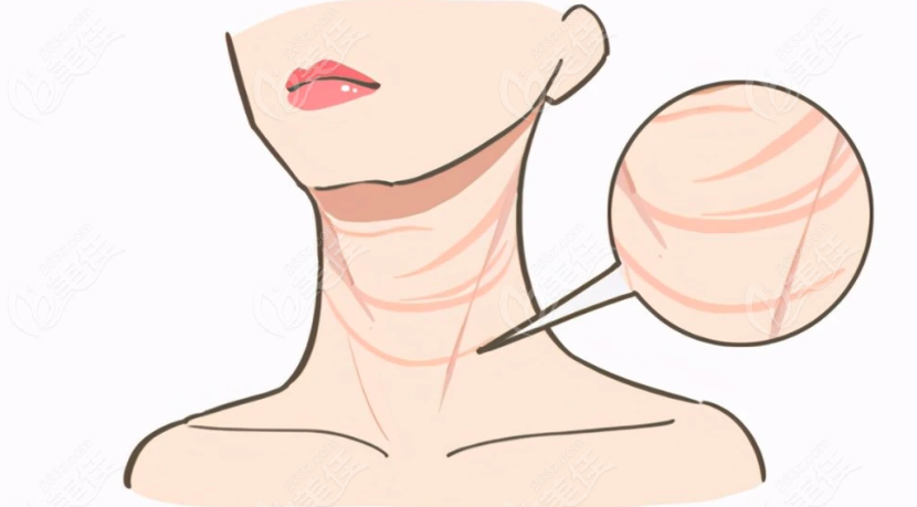 頸紋拉皮手術(shù)過程