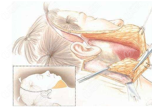 頸部拉皮手術(shù)能夠維持多少年